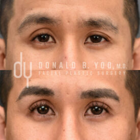 Upper blepharoplasty with Asian double eyelid creation