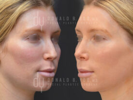 Revision rhinoplasty and septoplasty
