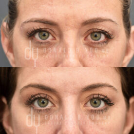 Upper blepharoplasty