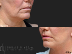 Deep plane facelift
