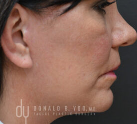Deep plane facelift