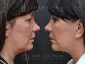 Deep plane facelift