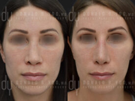 Revision rhinoplasty with rib cartilage and diced cartilage fascia (DCF)