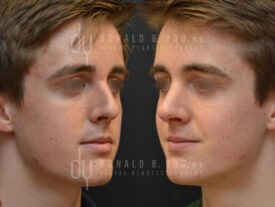 Primary rhinoplasty and septoplasty
