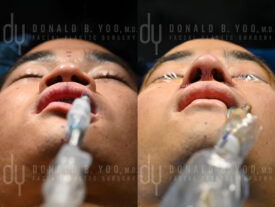 Asian rhinoplasty with rib cartilage, diced cartilage fascia (DCF) and alarplasty
