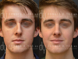 Male rhinoplasty with rib cartilage and diced cartilage fascia (DCF)