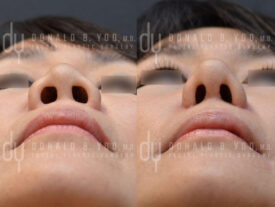Asian rhinoplasty with rib cartilage, diced cartilage fascia (DCF) and alarplasty