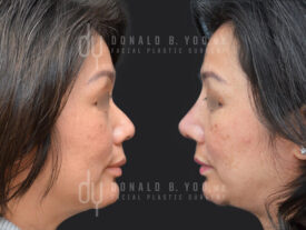 Asian Rhinoplasty with rib cartilage, diced cartilage fascia (DCF) and alarplasty
