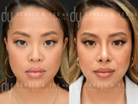 Primary rhinoplasty and septoplasty
