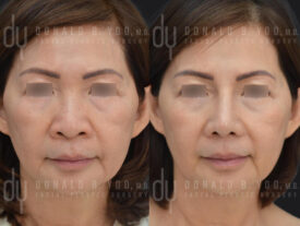 Asian rhinoplasty with rib cartilage, diced cartilage fascia (DCF) and alarplasty