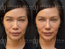 Revision rhinoplasty with rib cartilage and diced cartilage fascia (DCF)