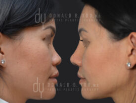 Asian Rhinoplasty with rib cartilage, diced cartilage fascia (DCF) and alarplasty