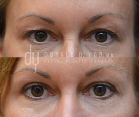 Upper blepharoplasty