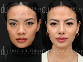 Primary rhinoplasty and septoplasty