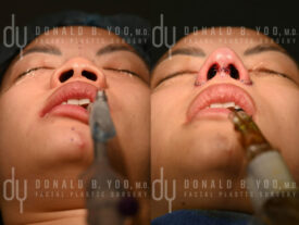 Asian rhinoplasty with rib cartilage, diced cartilage fascia (DCF) and alarplasty
