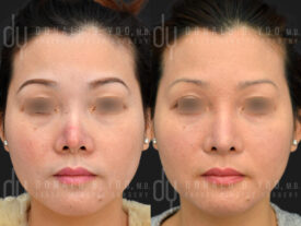 Revision rhinoplasty with rib cartilage, diced cartilage fascia (DCF) and silicone implant removal