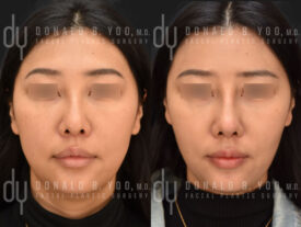 Asian Rhinoplasty with rib cartilage and diced cartilage fascia (DCF)