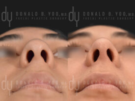 Rhinoplasty with rib cartilage, diced cartilage fascia (DCF) and alarplasty