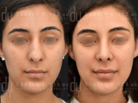 Primary rhinoplasty and septoplasty
