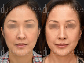 Asian Rhinoplasty with alar base modification