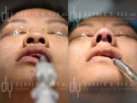 Asian rhinoplasty with rib cartilage, diced cartilage fascia (DCF) and alarplasty