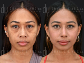 Asian Rhinoplasty with alarplasty