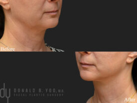 Facelift and necklift