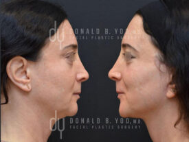 Deep plane facelift
