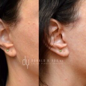 Deep plane facelift