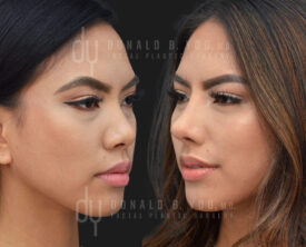 Asian Rhinoplasty with rib cartilage, diced cartilage fascia (DCF) and alarplasty