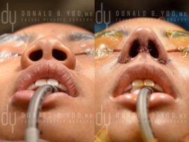 Asian rhinoplasty with rib cartilage, diced cartilage fascia (DCF) and alarplasty