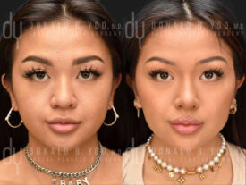 Asian Rhinoplasty with rib cartilage, diced cartilage fascia (DCF) and alarplasty