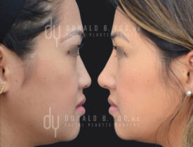 Asian Rhinoplasty with rib cartilage and diced cartilage fascia (DCF)
