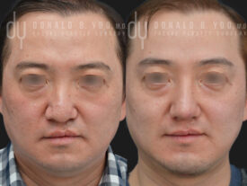 Male rhinoplasty with rib cartilage and diced cartilage fascia (DCF)