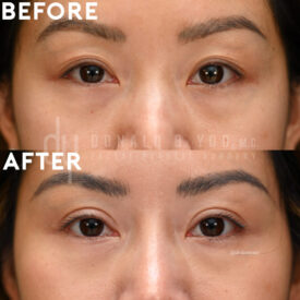 Upper blepharoplasty