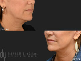 Deep plane facelift