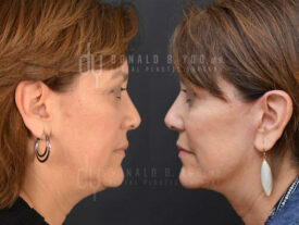 Deep plane facelift