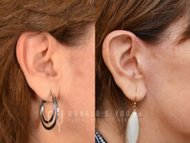 Deep plane facelift