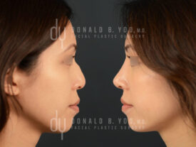 Asian Rhinoplasty with rib cartilage and diced cartilage fascia (DCF)