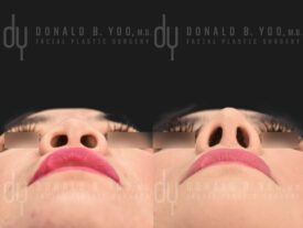 Rhinoplasty with rib cartilage, diced cartilage fascia (DCF) and alarplasty
