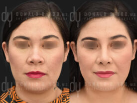 Primary rhinoplasty and submental liposuction