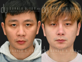 Male rhinoplasty with rib cartilage and diced cartilage fascia (DCF)