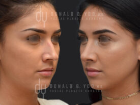 Primary rhinoplasty and septoplasty
