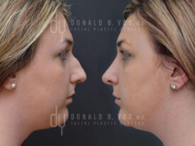 Primary rhinoplasty and septoplasty