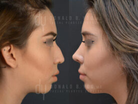 Primary rhinoplasty and septoplasty