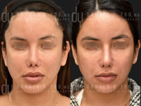 Revision rhinoplasty with rib cartilage and diced cartilage fascia (DCF)