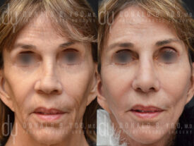 Deep plane facelift and rhinoplasty
