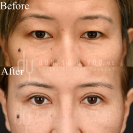 Upper blepharoplasty