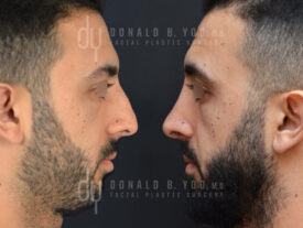Primary rhinoplasty and septoplasty
