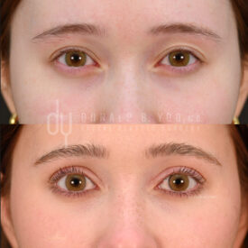 Upper blepharoplasty